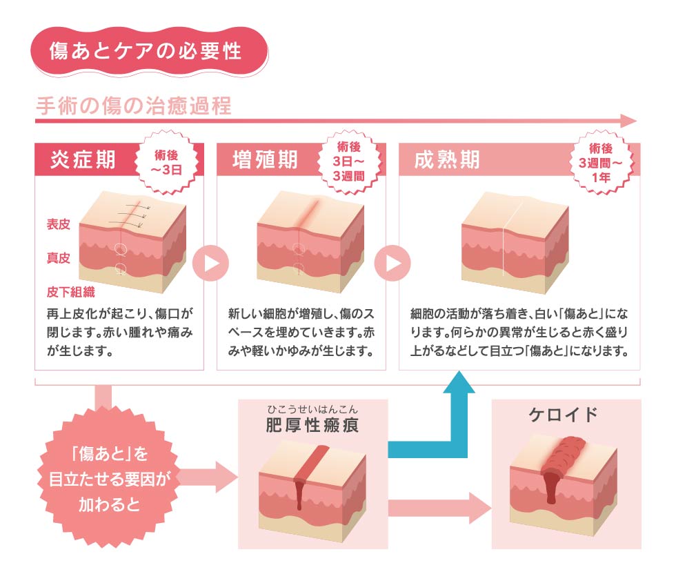 肥厚性瘢痕(ひこうせいはんこん)を傷あとテープで予防
